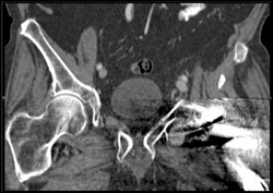 Small Pseudoaneurysm- Left Groin S/P Total Hip Replacement (THR) - CTisus CT Scan