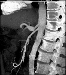 Celiac Artery Aneurysm - CTisus CT Scan