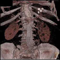 Superior Mesenteric Artery (SMA) Stenosis - CTisus CT Scan