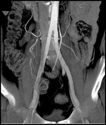 Dissection Right External Iliac Artery S/P Angiogram - CTisus CT Scan