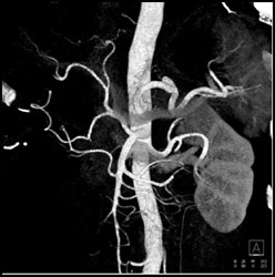 Normal Celiac Artery - CTisus CT Scan