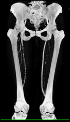 Diseased Right Superficial Femoral Artery (SFA) - CTisus CT Scan