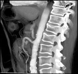 Median Arcuate Ligament Syndrome - CTisus CT Scan