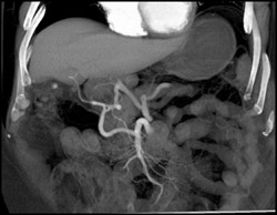 Median Arcuate Ligament Syndrome - CTisus CT Scan