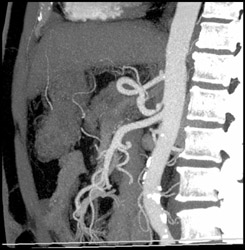 Median Arcuate Ligament Syndrome - CTisus CT Scan