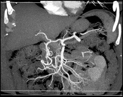 Median Arcuate Ligament Syndrome - CTisus CT Scan