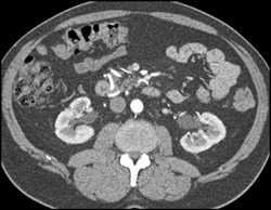 Median Arcuate Ligament Syndrome - CTisus CT Scan