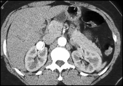 Renal Artery Aneurysms - CTisus CT Scan