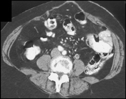 Gonadal Vein Thrombosis - CTisus CT Scan