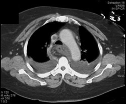 Clot in SVC - CTisus CT Scan