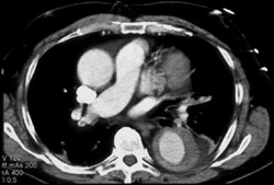 Aortic Dissection - CTisus CT Scan