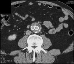 Endoleak - CTisus CT Scan