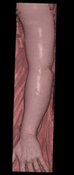 CTA Arm Showing Skin - CTisus CT Scan