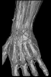 Dorsal Arcade Hand - CTisus CT Scan