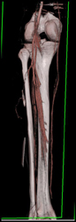 Normal Trifurcation Vessels - CTisus CT Scan