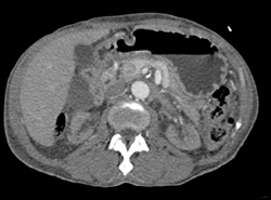 Narrowed Celiac Artery - CTisus CT Scan