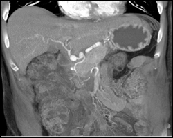 Hepatic Artery Aneurysm - CTisus CT Scan