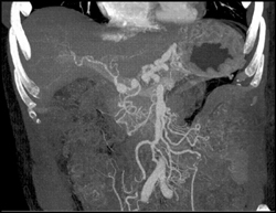 Hepatic Artery Aneurysm - CTisus CT Scan