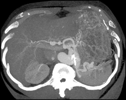 Hepatic Artery Aneurysm - CTisus CT Scan