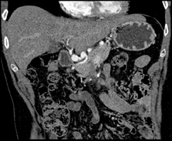 Hepatic Artery Aneurysm - CTisus CT Scan