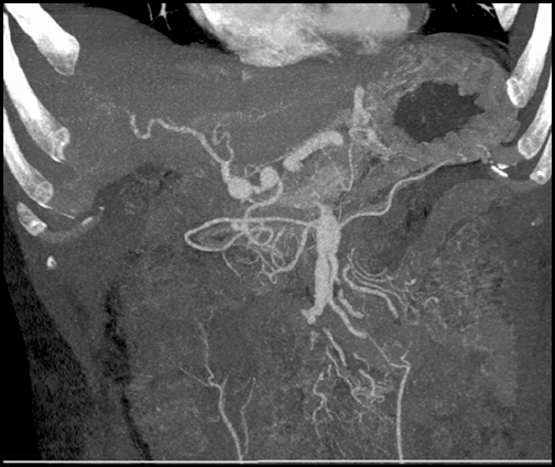 Hepatic Artery Aneurysm - CTisus CT Scan