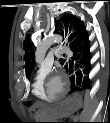 Calcified Plaques in Arch Vessels - CTisus CT Scan