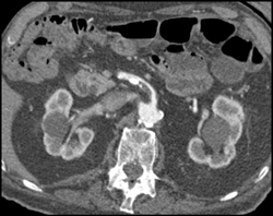 Clot in Proximal SMA - CTisus CT Scan