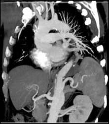 Arch Using MIP and VRT - CTisus CT Scan