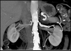 Stenosis of Both Renal Arteries - CTisus CT Scan