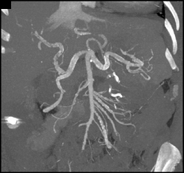 Atherosclerotic Disease in Splenic Artery - CTisus CT Scan