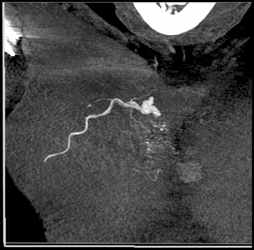 Pseudoaneurysm Chest Wall S/P Stab Wound - CTisus CT Scan