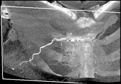 Post Embolization of the Pseudoaneurysm - CTisus CT Scan