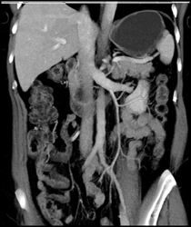 Normal Left Gonadal Vein - CTisus CT Scan