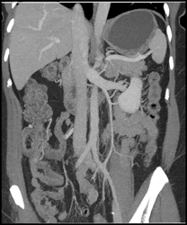 Normal Left Adrenal Vein - CTisus CT Scan