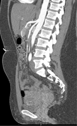 SMA and Celiac Artery From Common Origin - CTisus CT Scan