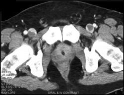 Bilateral Deep Vein Thrombosis (DVT) - CTisus CT Scan