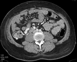 Varices Around Cecum From Cirrhosis - CTisus CT Scan