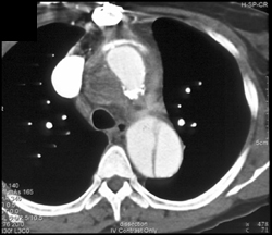 Aortic Dissection - CTisus CT Scan