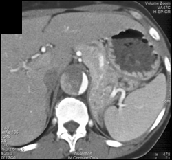 Aortic Dissection - CTisus CT Scan