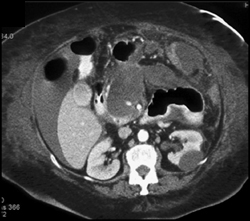 Gastroduodenal Artery (GDA) Pseudoaneurysm - CTisus CT Scan