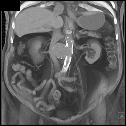 Focal Aneurysm Off Aorta - CTisus CT Scan