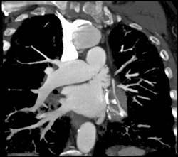 Diseased LAD - CTisus CT Scan