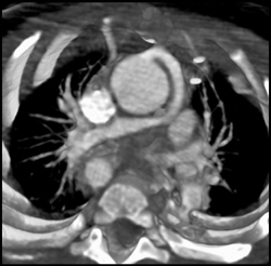 Chd Pulmonary Artery Arises Off Aorta - CTisus CT Scan