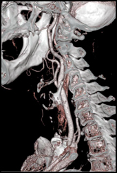 Internal Carotid Artery Stenosis - CTisus CT Scan