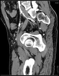 Diseased and Occluded External Iliac Artery - CTisus CT Scan