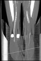 Diseased Superficial Femoral Arteries (SFAs) - CTisus CT Scan