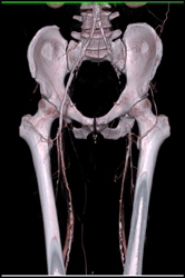 Diseased Superficial Femoral Arteries (SFAs) - CTisus CT Scan