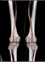 Diseased Superficial Femoral Arteries (SFAs) - CTisus CT Scan