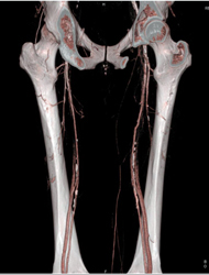 Diseased Superficial Femoral Arteries (SFAs) - CTisus CT Scan