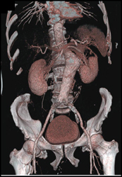 Abdominal Aortic Aneurysm (AAA) - CTisus CT Scan